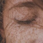 ¿Cómo cuido mi piel con dermatitis atópica? 