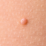 Moluscos contagiosos